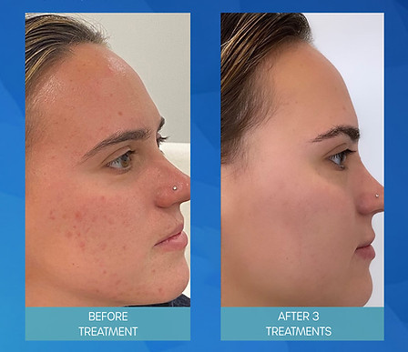 B&A SKinpen hypergimentation.jpg