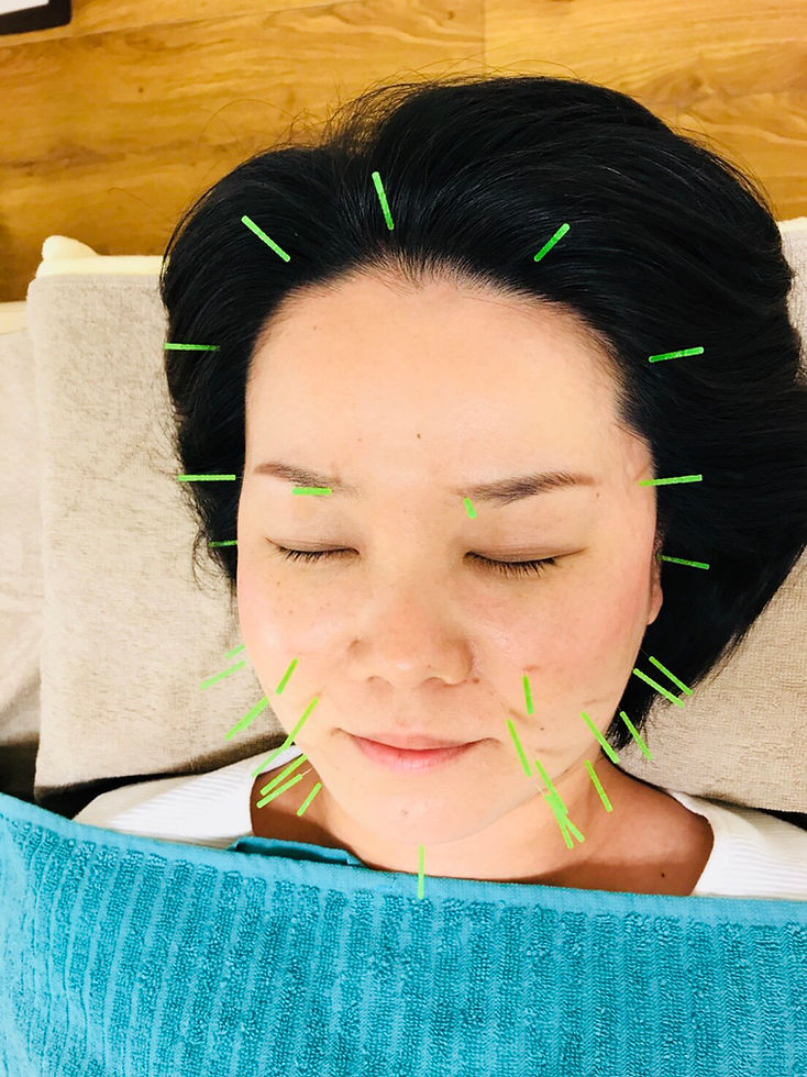 美容鍼とは?痛みや効果、施術前に知っておきたいこと