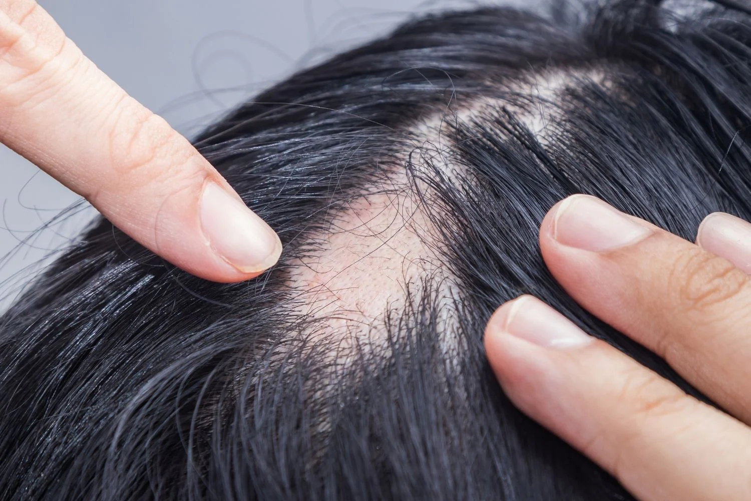 alopecia-areata.webp