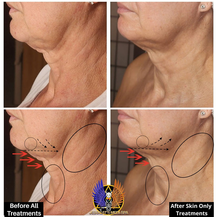 Skin Tightening Treatments Before and After