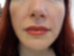 Athena Corrective Lips After 2
