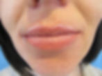 Athena Corrective Lips Before 3
