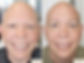 Athena Karsant Alopecia