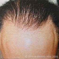 Athena Thinning Hair Camo Before 2