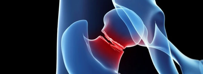 ¿Qué hacer en caso de una fractura?