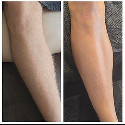 före och efter resultat på sockervaxade ben.