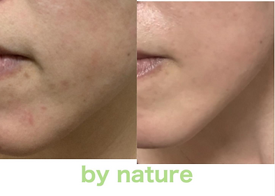 プライベートエステサロン ｜Nature｜ナチュール｜ 兵庫県｜尼崎市｜武庫之荘｜しわ｜しみ｜たるみ｜むくみ｜エイジングケア｜リンパオイルトリートメント｜深爪｜噛爪｜子どもの爪噛み癖｜ハーバルピール｜オーガニックプレミアムジャパン｜シミケア｜ニキビ｜トラブル肌｜エステスクール｜ヘッドマッサージスクール｜大阪｜塚口｜西宮北口｜西宮｜伊丹｜アロママッサージ｜