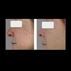 Radio frequency facial contouring to tighten skin and improve collagen production, with laser skin rejuvenation to remove dark spots and sun damage at Glowology Laser in Okotoks,