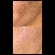 Sun damage textural repair with laser skin rejuvenation at Glowology Laser in Okotoks