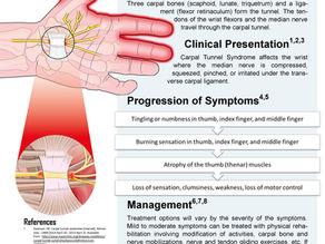 Are you losing grip strength? It could be Carpal Tunnel Syndrome!