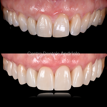 Faccette estetiche dentali