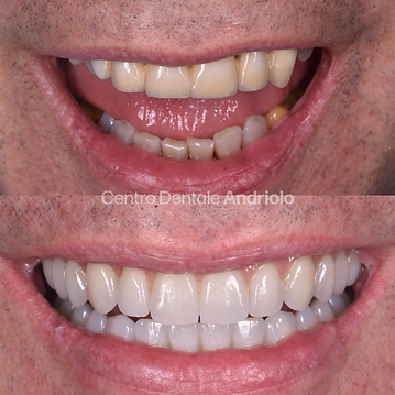 Fixed teeth on implants