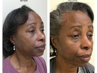 SHE LOOKS AMAZING WITH HER NEW FACELIFT...YOU CAN TOO!!