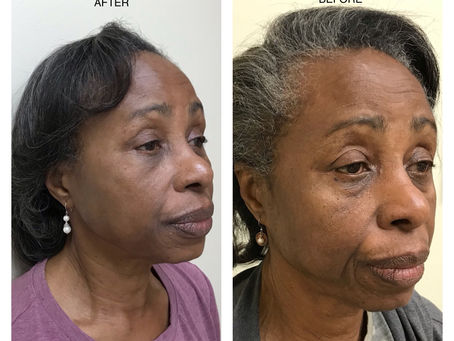 SHE LOOKS AMAZING WITH HER NEW FACELIFT...YOU CAN TOO!!