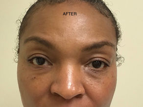 PRF FILLERS IN THE PERI-OCULAR(EYE) AREA.