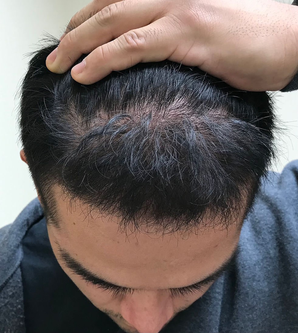HAIR LOSS TREATMENT