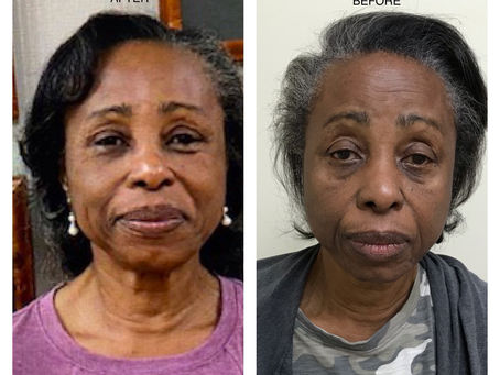 LOOK WHAT A FACELIFT CAN DO!!