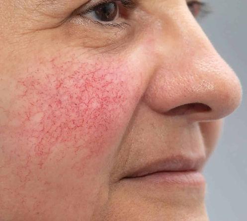 dermatologo-especialista-en-rosacea-en-valencia-clinica-dermar.jpg