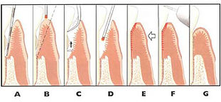 periodontitis northridge