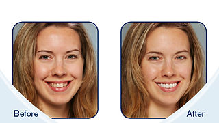95-5477_lsdp_before_after_digital_frame