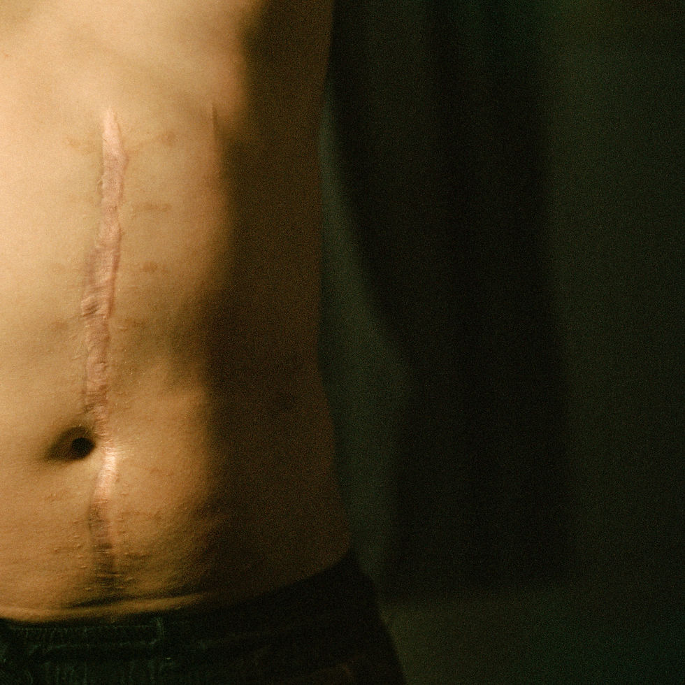 Ukrainian war veteran's abdomen showing a long, vertical scar