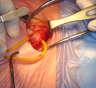 Right_Inguinal_Hernia.jpg