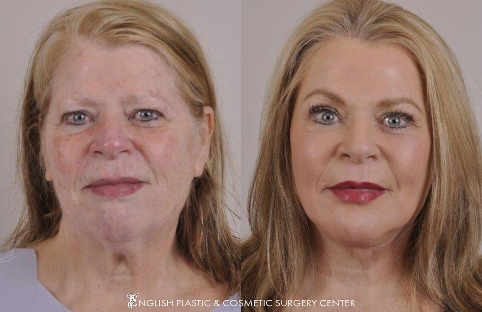 EnglishPlasticAndCosmeticSurgeryCenter-Facelift-BeforeAfter-Case155-1.jpg