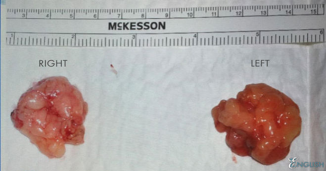 A Thinner Face: Buccal Fat Removal
