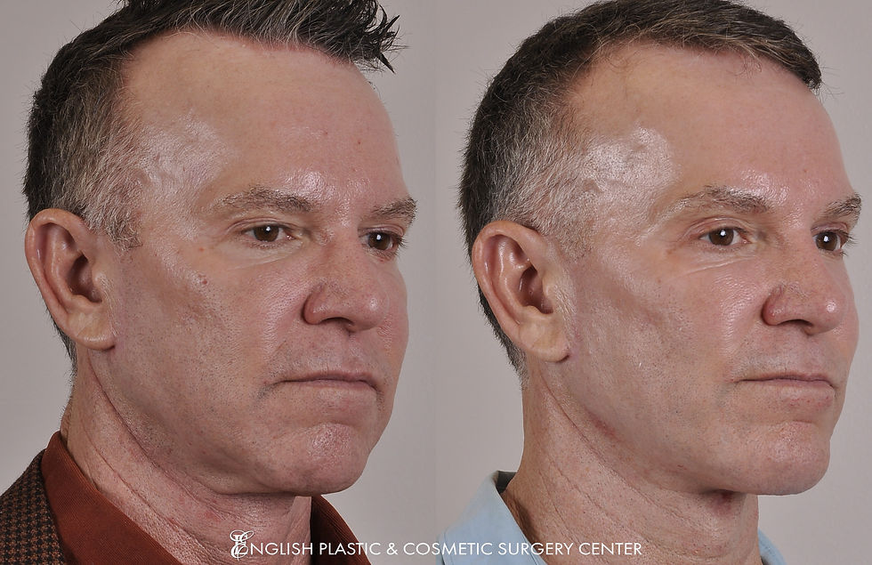 EnglishPlasticAndCosmeticSurgeryCenter-Facelift-BeforeAfter-Case178-2.jpg