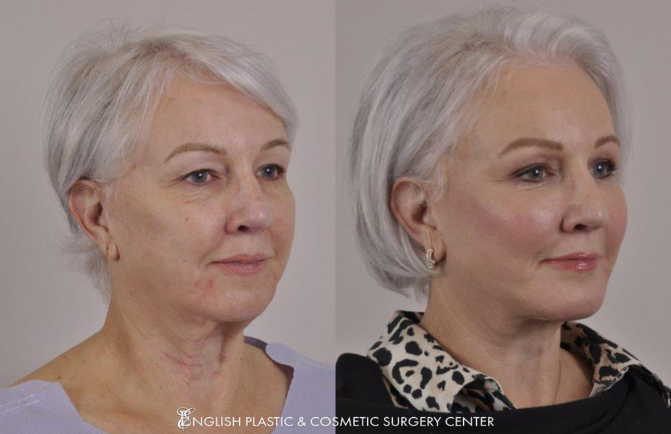 EnglishPlasticAndCosmeticSurgeryCenter-Facelift-BeforeAfter-Case164-2.jpg