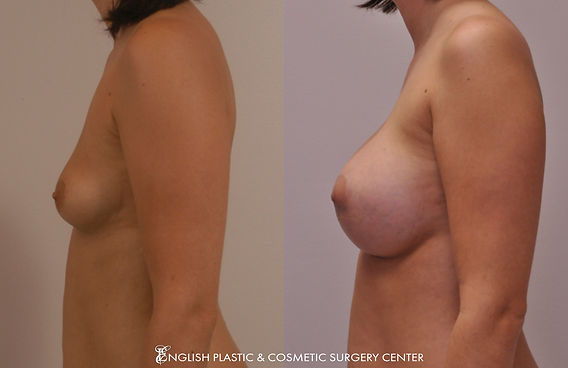 Before and after images of a woman after undergoing a breast augmentation (breast implants) by Dr. Jim English at English Plastic & Cosmetic Surgery Center in Little Rock, AR | Case 13