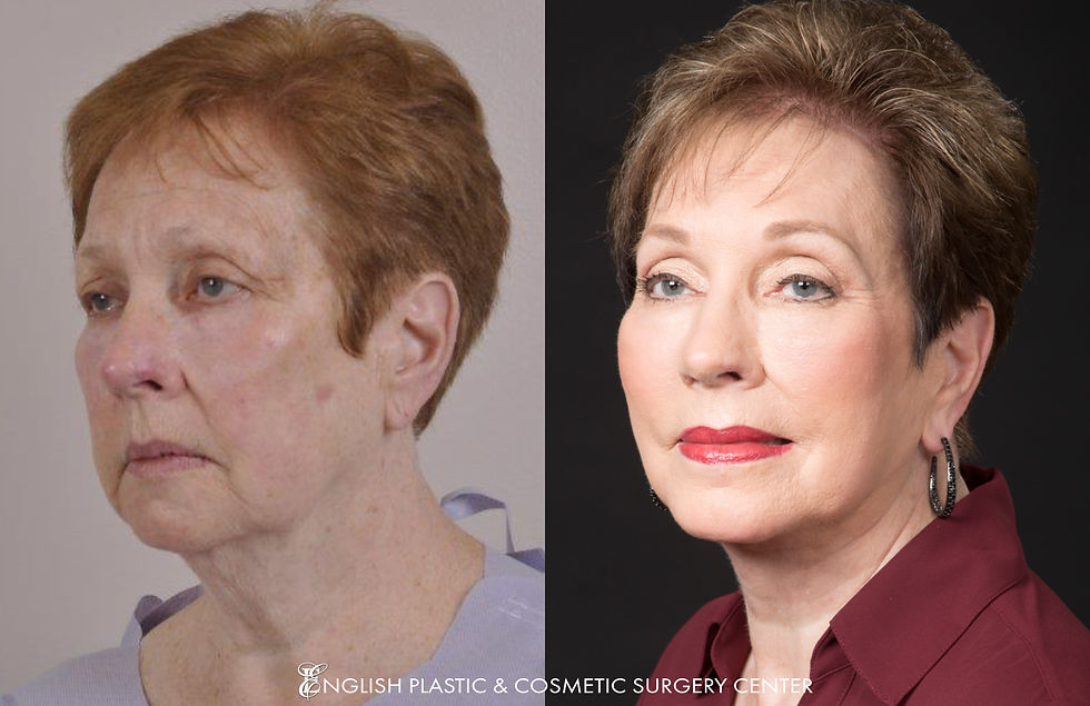 EnglishPlasticAndCosmeticSurgeryCenter-Facelift-BeforeAfter-Case158-1.jpg
