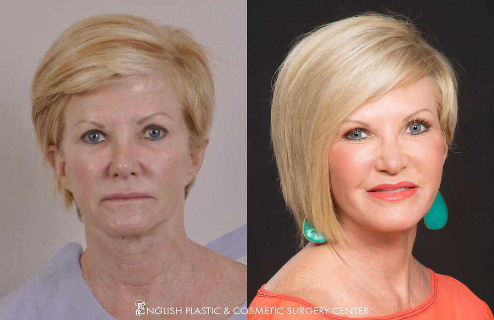 EnglishPlasticAndCosmeticSurgeryCenter-Facelift-BeforeAfter-Case156-1.jpg