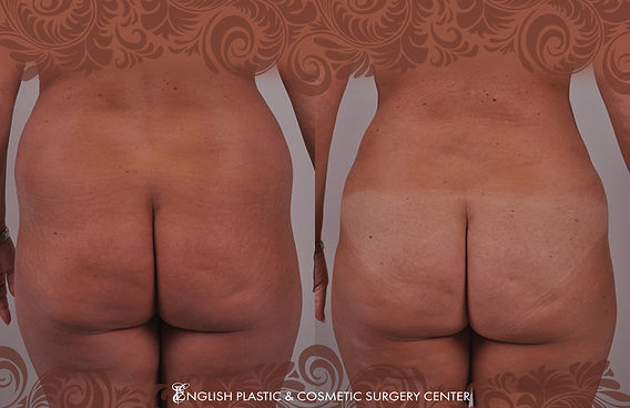 Before and after images of a woman after undergoing liposuction by Dr. Jim English at English Plastic & Cosmetic Surgery Center in Little Rock, AR | Case 3