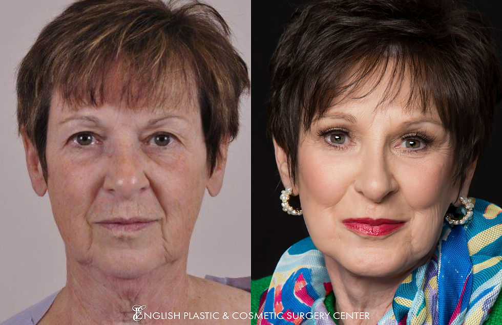 EnglishPlasticAndCosmeticSurgeryCenter-Facelift-BeforeAfter-Case209-1.jpg