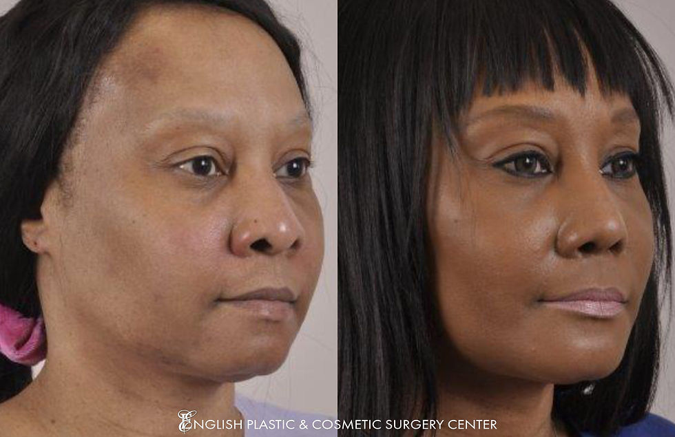 EnglishPlasticAndCosmeticSurgeryCenter-Facelift-BeforeAfter-Case192-1.jpg