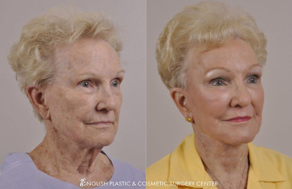 Dr. Jim English | Brow Lift Case 24