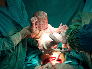 Fast Forward From C-Sections Unnecessary and Dangerous to Not Enough Shows Pendulum Swings Too Far are Dangerous and Unnecessary Or Is It In the Reporting of the Studies