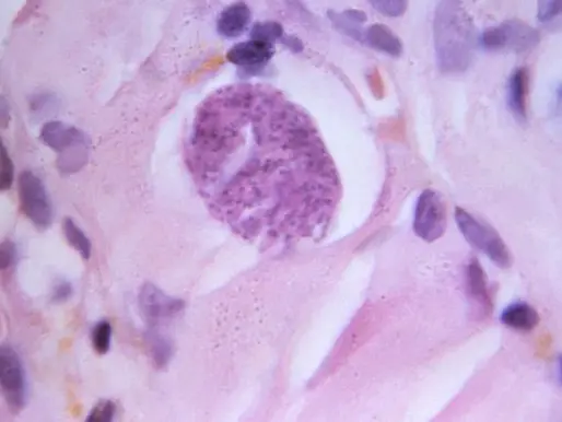 toxoplasmosis
