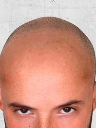 Haarpigmentierung (SMP) Braunschweig