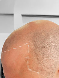 Haarpigmentierung (SMP) Braunschweig