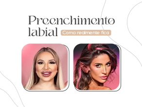 Preenchimento labial: como realmente fica?