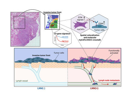 Identifying the Cellular "Accomplices" That Drive Oral Cancer Metastasis