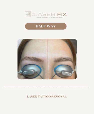 Before and after of laser tattoo removal for microblading.