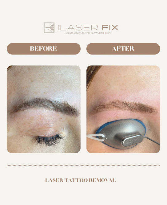 Before and after of laser tattoo removal for microblading.