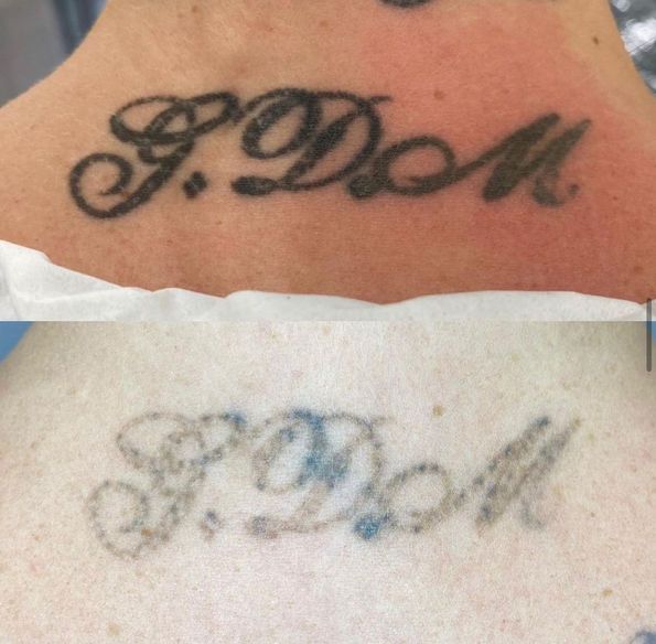 Before and after of back tattoo removal.