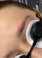 Laser removing eyebrow microblading.