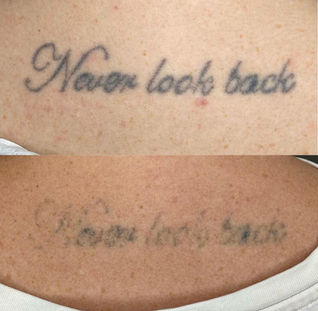 Before and after of back tattoo removal