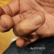 Soigner une verrue naturellement