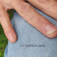 comment une verrue ?